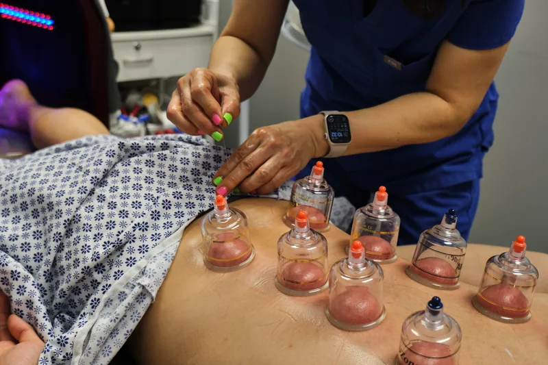 Cupping therapy session at KARA Med Spa